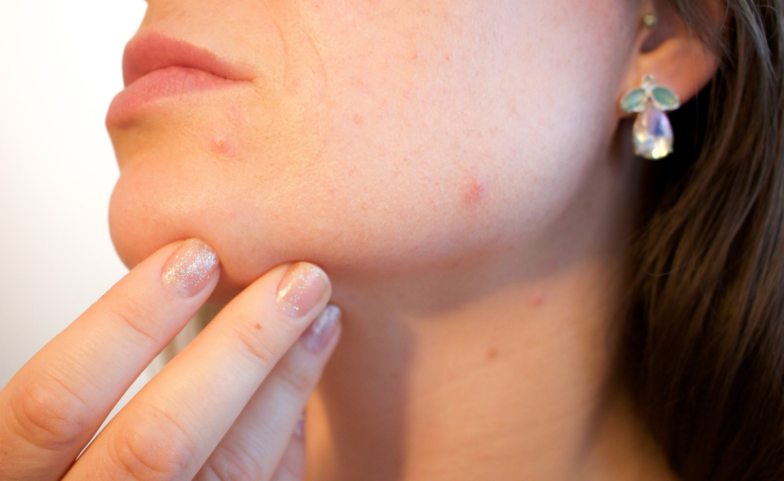 Quanti tipi di acne esistono? Ecco tutto ciò che c'è da sapere